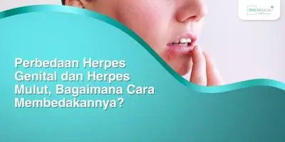 Perbedaan Herpes Genital dan Herpes Mulut, Bagaimana Cara Membedakannya?