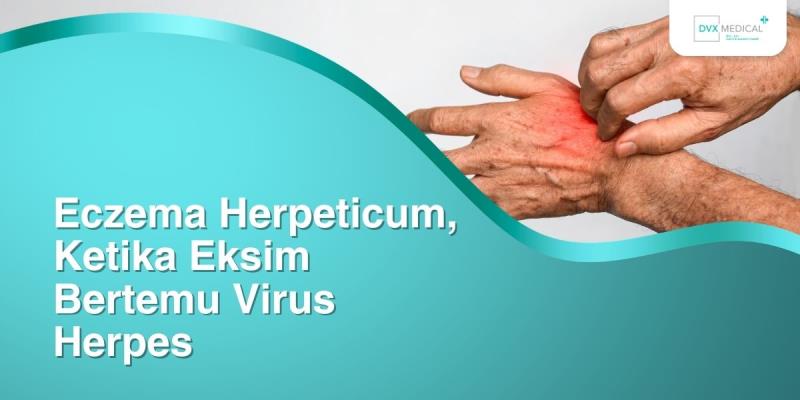 Eczema Herpeticum, Ketika Eksim Bertemu Virus Herpes