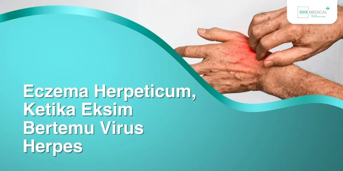 Eczema Herpeticum, Ketika Eksim Bertemu Virus Herpes