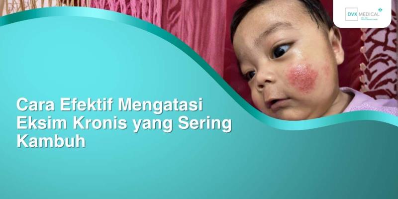 Cara Efektif Mengatasi Eksim Kronis yang Sering Kambuh