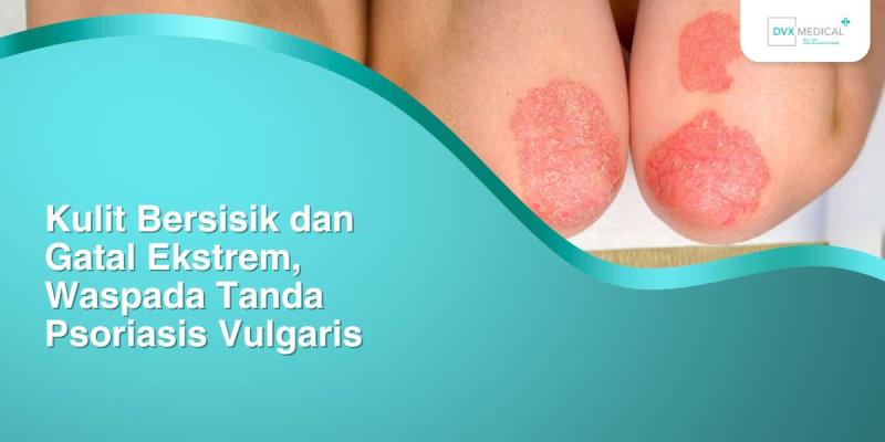 Kulit Bersisik dan Gatal Ekstrem, Waspada Tanda Psoriasis Vulgaris