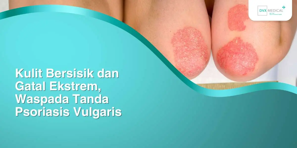 Kulit Bersisik dan Gatal Ekstrem, Waspada Tanda Psoriasis Vulgaris