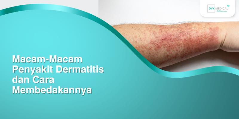 Macam-Macam Penyakit Dermatitis dan Cara Membedakannya