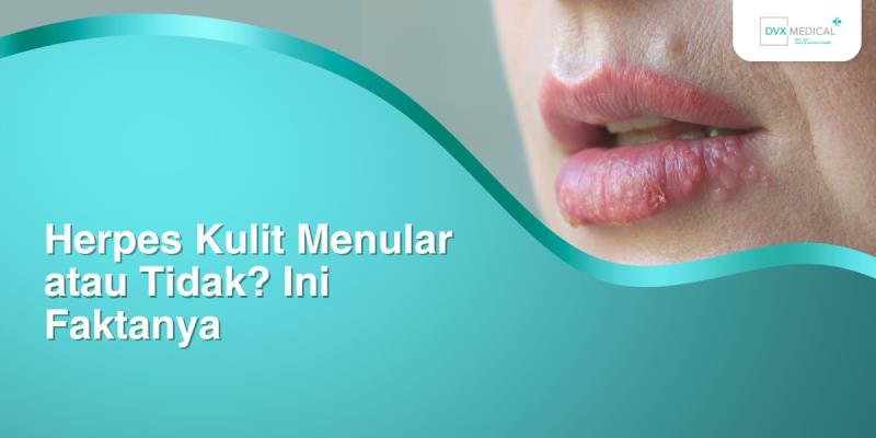 Herpes Kulit Menular atau Tidak? Ini Faktanya
