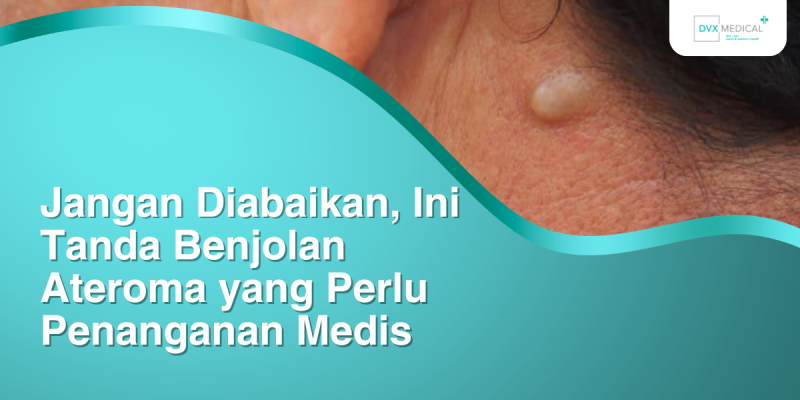 Jangan Diabaikan, Ini Tanda Benjolan Ateroma yang Perlu Penanganan Medis