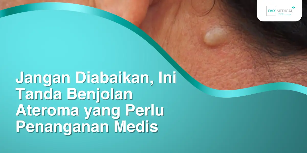 Jangan Diabaikan, Ini Tanda Benjolan Ateroma yang Perlu Penanganan Medis