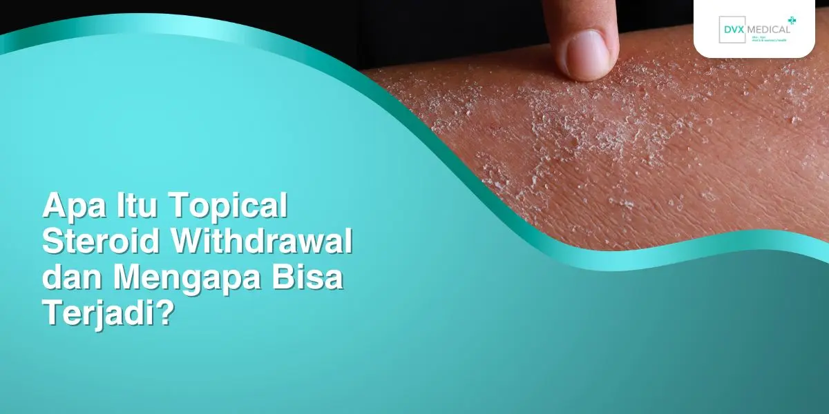 Apa Itu Topical Steroid Withdrawal dan Mengapa Bisa Terjadi?