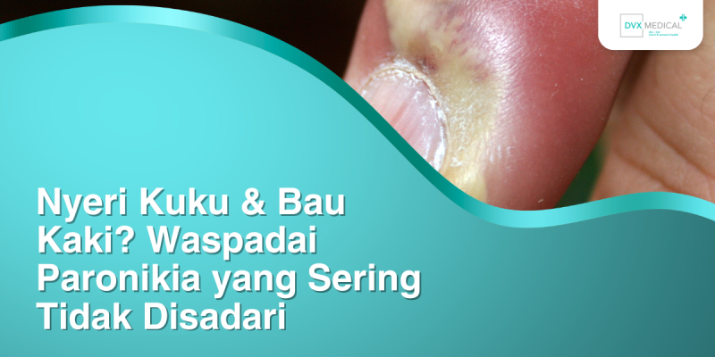 Nyeri Kuku & Bau Kaki? Waspadai Paronikia yang Sering Tidak Disadari