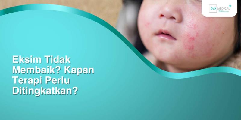 Eksim Tidak Membaik? Kapan Terapi Perlu Ditingkatkan?