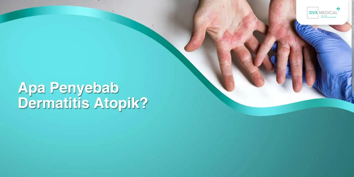 Apa Penyebab Dermatitis Atopik?