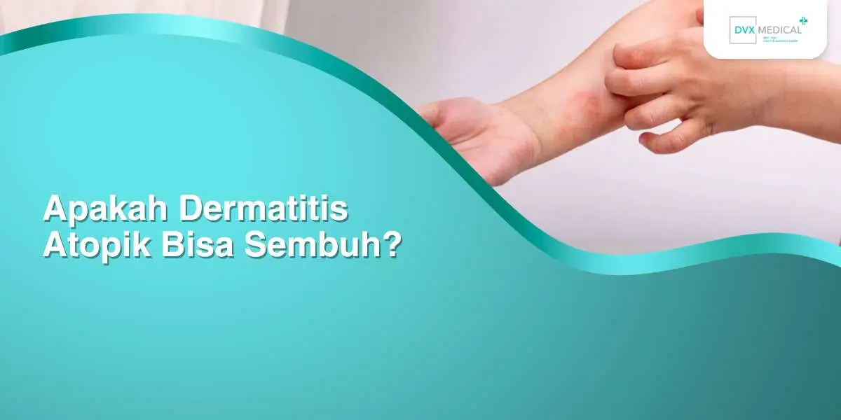 Apakah Dermatitis Atopik Bisa Sembuh?