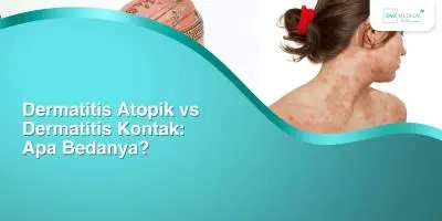 Dermatitis Atopik vs Dermatitis Kontak: Apa Bedanya?