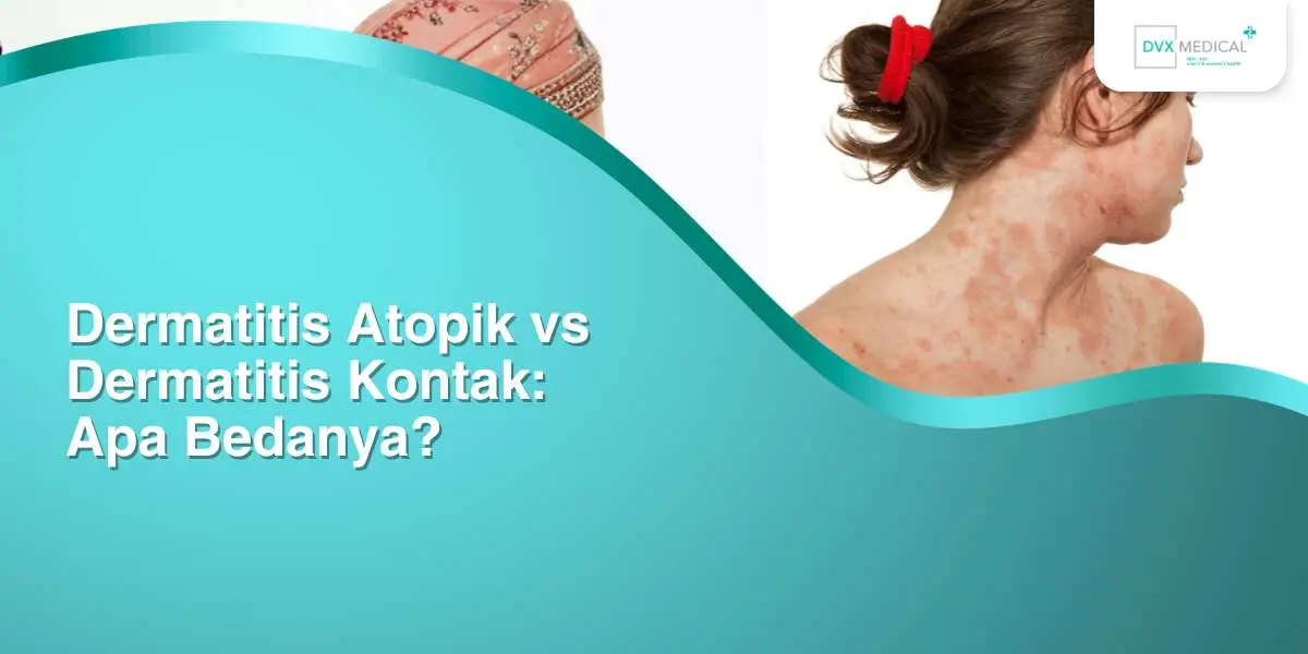 Dermatitis Atopik vs Dermatitis Kontak: Apa Bedanya?