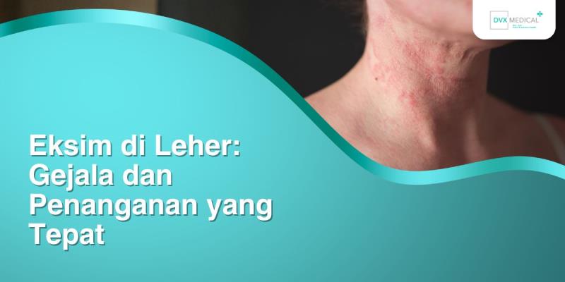 Eksim di Leher: Gejala dan Penanganan yang Tepat