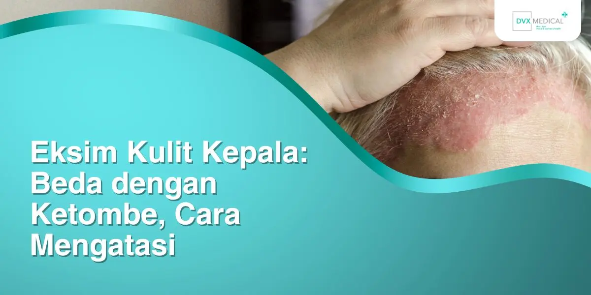 Eksim Kulit Kepala: Beda dengan Ketombe, Cara Mengatasi