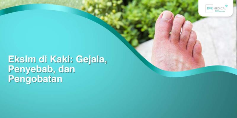 Eksim di Kaki: Gejala, Penyebab, dan Pengobatan