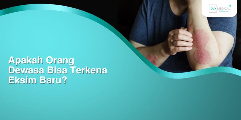 Apakah Orang Dewasa Bisa Terkena Eksim Baru?