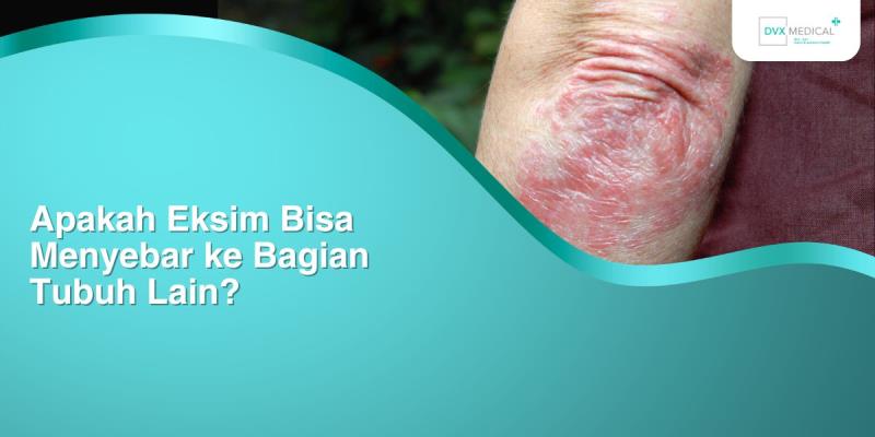 Apakah Eksim Bisa Menyebar ke Bagian Tubuh Lain?