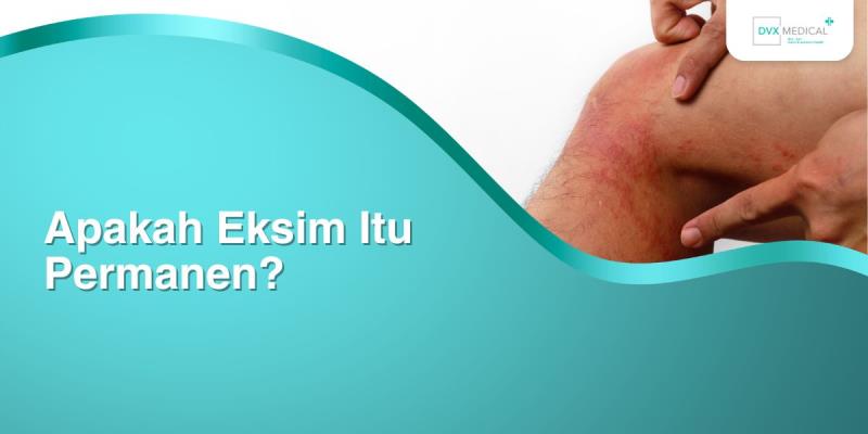 Apakah Eksim Itu Permanen?