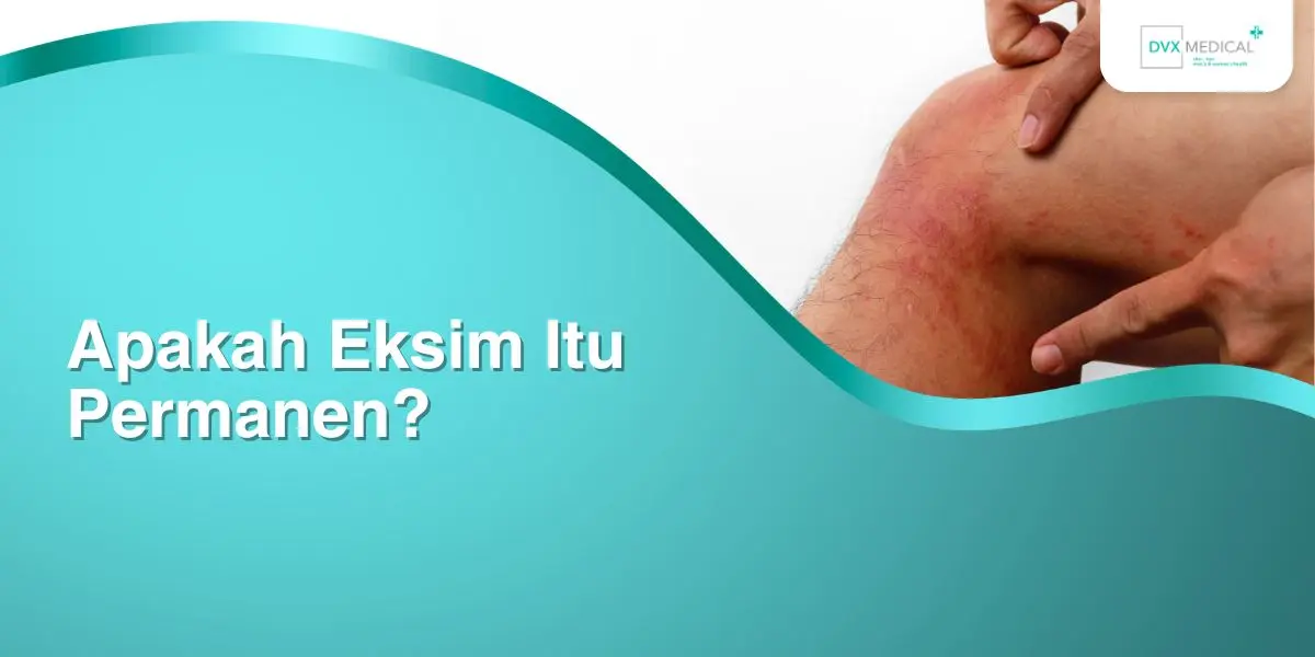 Apakah Eksim Itu Permanen?