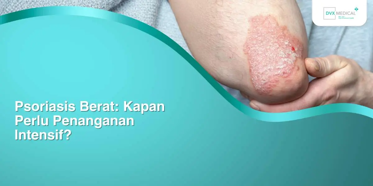 Psoriasis Berat: Kapan Perlu Penanganan Intensif?