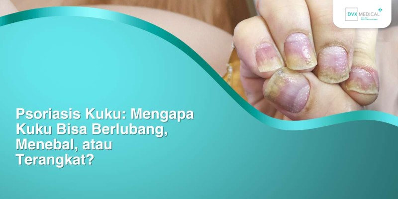 Psoriasis Kuku: Mengapa Kuku Bisa Berlubang, Menebal, atau Terangkat?