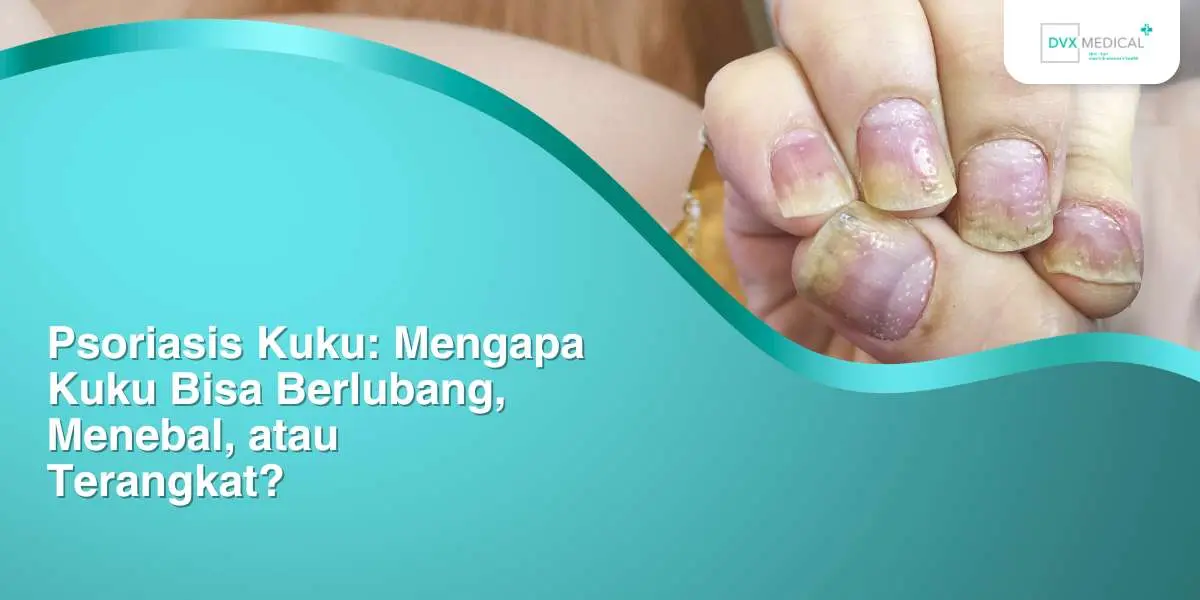 Psoriasis Kuku: Mengapa Kuku Bisa Berlubang, Menebal, atau Terangkat?