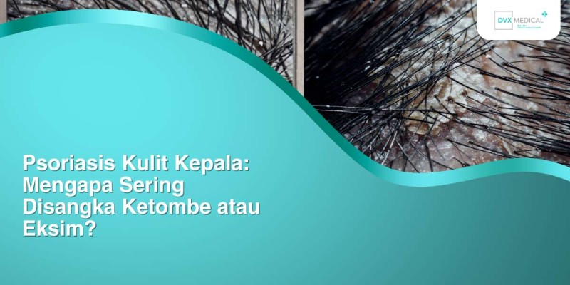 Psoriasis Kulit Kepala: Mengapa Sering Disangka Ketombe atau Eksim?