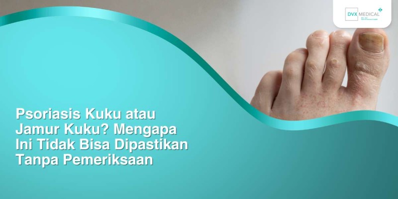 Psoriasis Kuku atau Jamur Kuku? Mengapa Ini Tidak Bisa Dipastikan Tanpa Pemeriksaan
