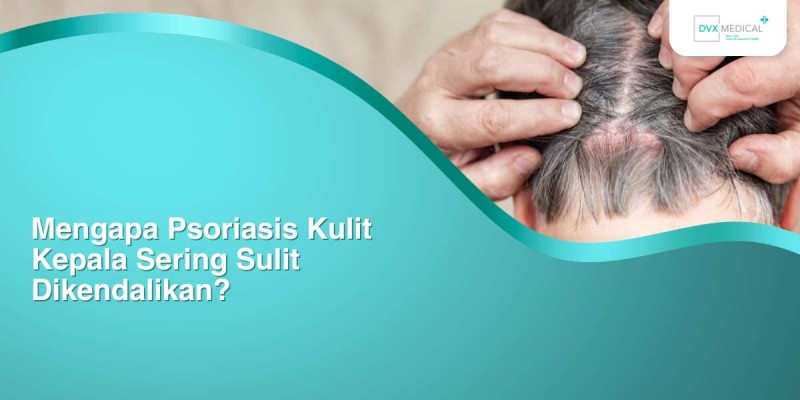 Mengapa Psoriasis Kulit Kepala Sering Sulit Dikendalikan?