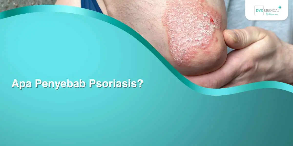 Apa Penyebab Psoriasis?
