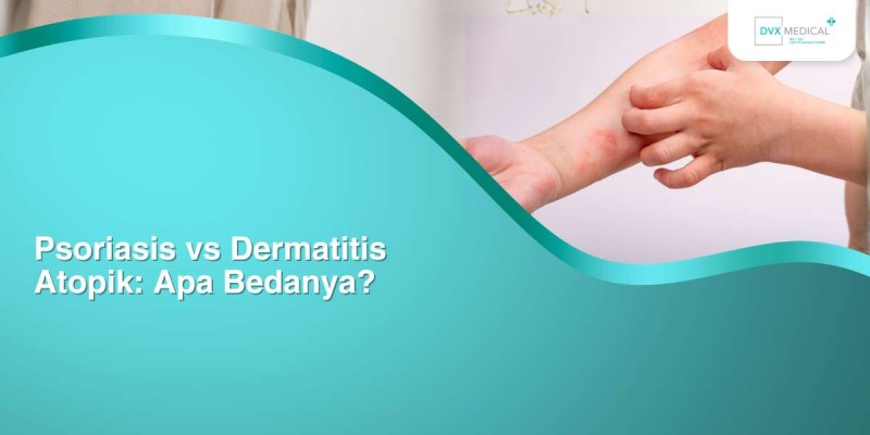 Psoriasis vs Dermatitis Atopik: Apa Bedanya?