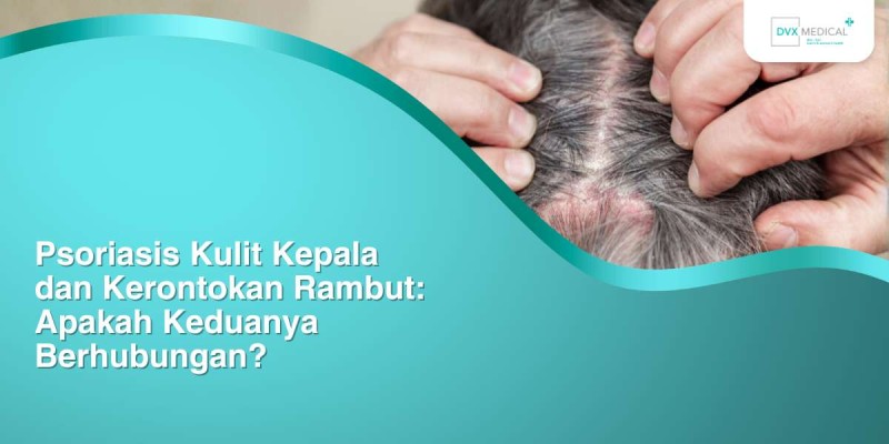 Psoriasis Kulit Kepala dan Kerontokan Rambut: Apakah Keduanya Berhubungan?