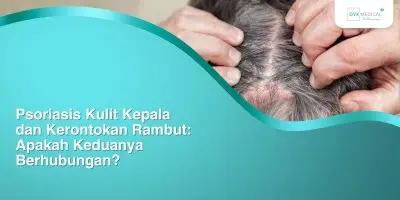 Psoriasis Kulit Kepala dan Kerontokan Rambut: Apakah Keduanya Berhubungan?