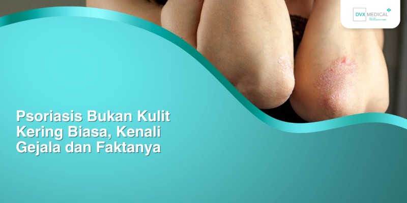 Psoriasis Bukan Kulit Kering Biasa, Kenali Gejala dan Faktanya