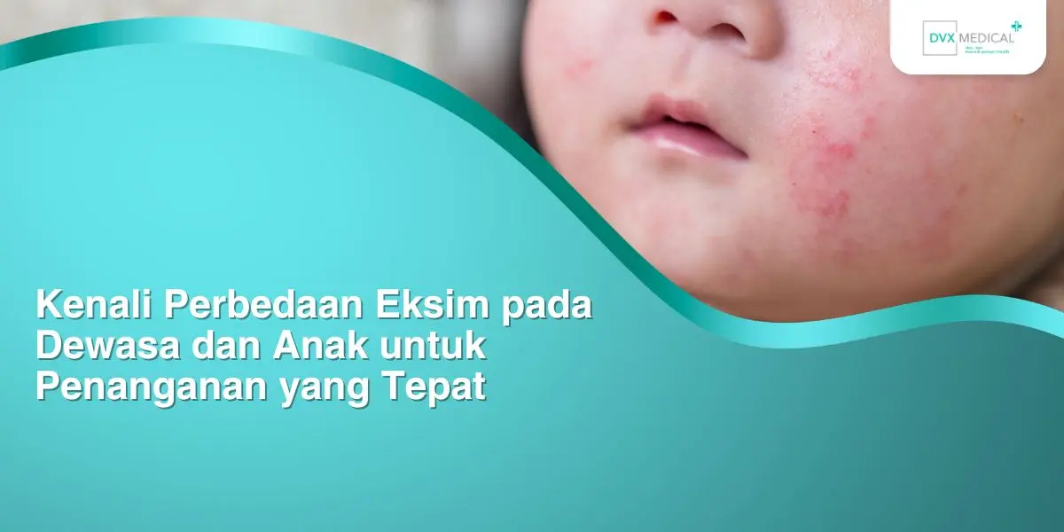 Kenali Perbedaan Eksim pada Dewasa dan Anak untuk Penanganan yang Tepat