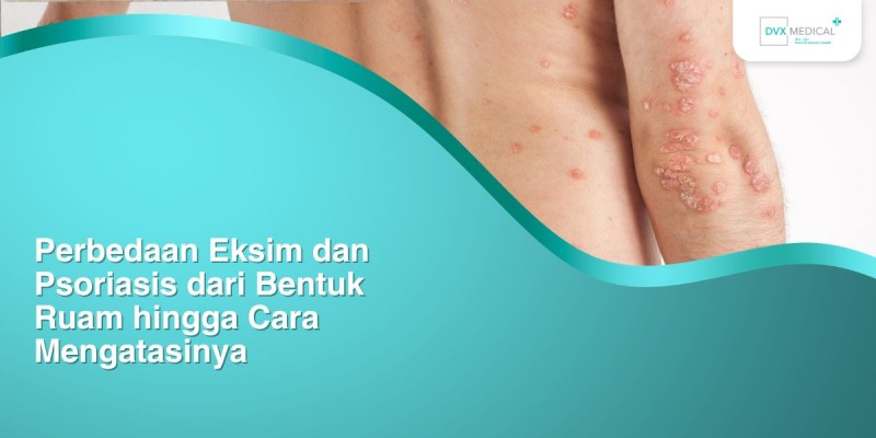 Perbedaan Eksim dan Psoriasis dari Bentuk Ruam hingga Cara Mengatasinya