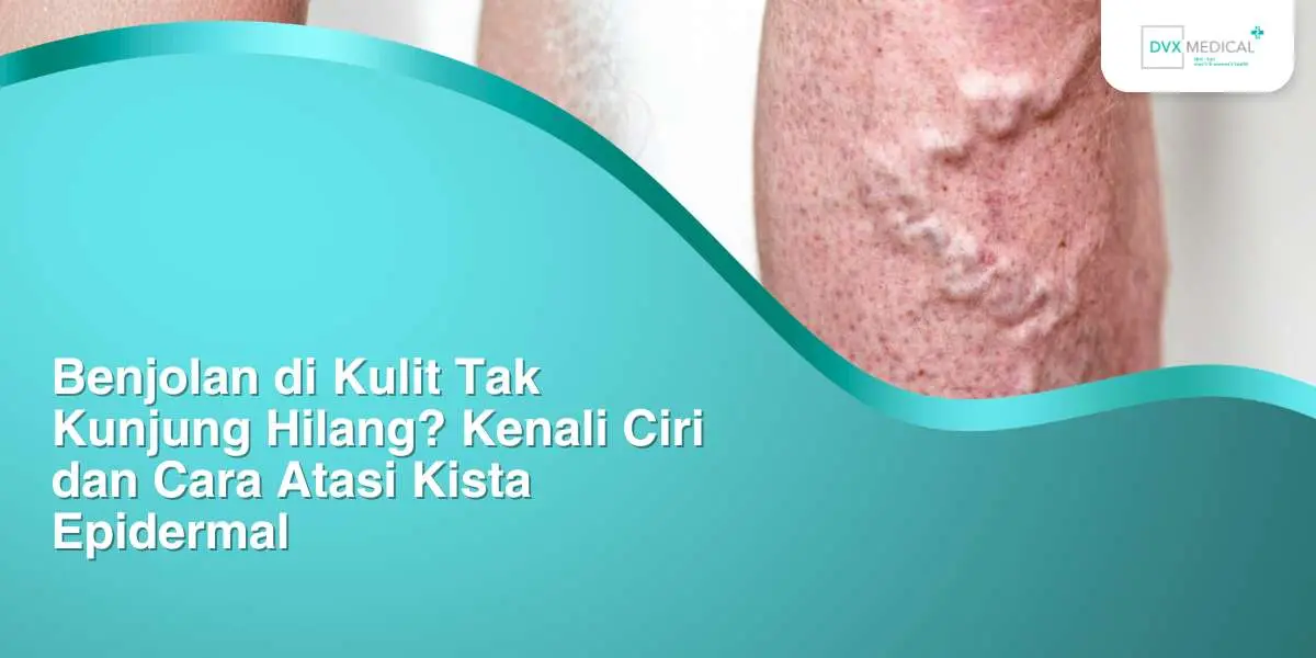Benjolan di Kulit Tak Kunjung Hilang? Kenali Ciri dan Cara Atasi Kista Epidermal