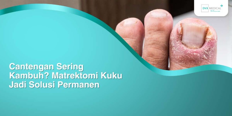 Cantengan Sering Kambuh? Matrektomi Kuku Jadi Solusi Permanen