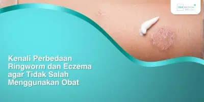 Kenali Perbedaan Ringworm dan Eczema agar Tidak Salah Menggunakan Obat
