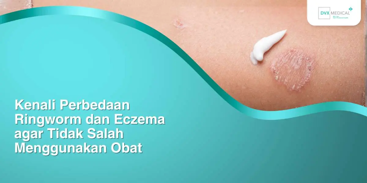 Kenali Perbedaan Ringworm dan Eczema agar Tidak Salah Menggunakan Obat