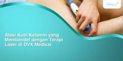 Atasi Kutil Kelamin yang Membandel dengan Terapi Laser di DVX Medical