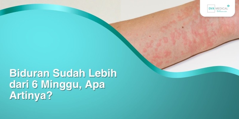 Biduran Sudah Lebih dari 6 Minggu, Apa Artinya?
