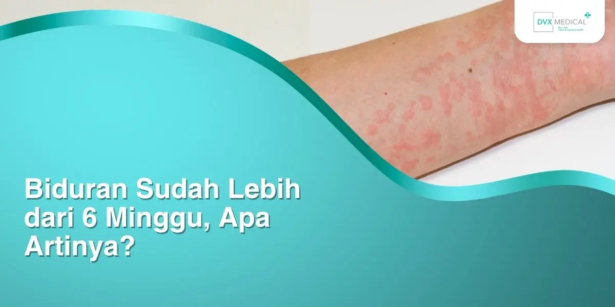 Biduran Sudah Lebih dari 6 Minggu, Apa Artinya? Biduran Sudah Lebih dari 6 Minggu, Apa Artinya?
