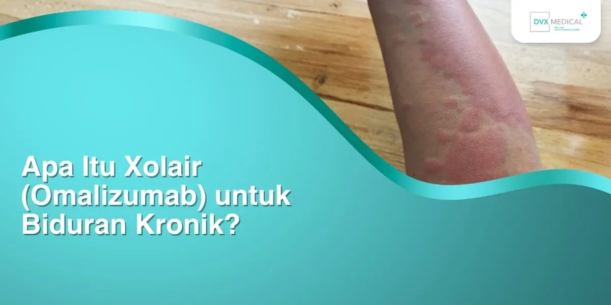 Apa Itu Xolair (Omalizumab) untuk Biduran Kronik? Apa Itu Xolair (Omalizumab) untuk Biduran Kronik?