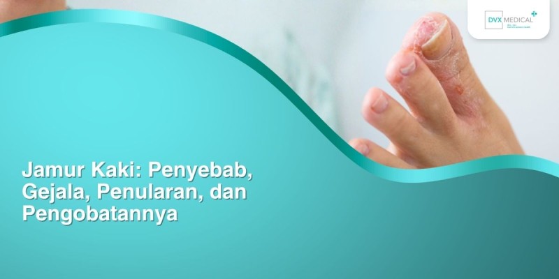 Jamur Kaki: Penyebab, Gejala, Penularan, dan Pengobatannya