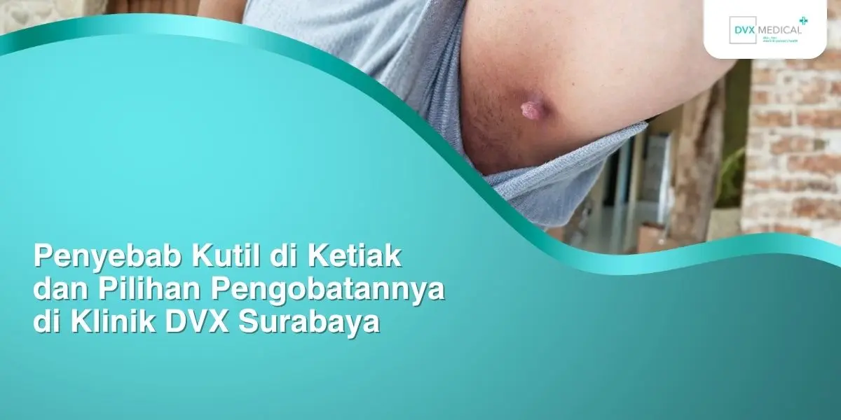 Penyebab Kutil di Ketiak dan Pilihan Pengobatannya di Klinik DVX Surabaya