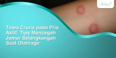 Tinea Cruris pada Pria Aktif: Tips Mencegah Jamur Selangkangan Saat Olahraga