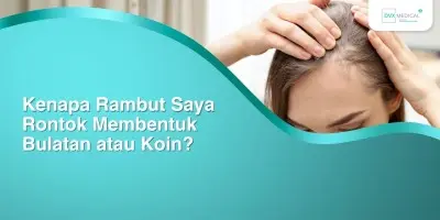 Kenapa Rambut Saya Rontok Membentuk Bulatan atau Koin?