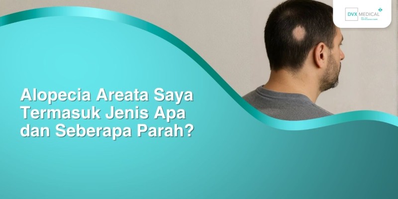 Alopecia Areata Saya Termasuk Jenis Apa dan Seberapa Parah?